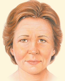 endoscopic facelift