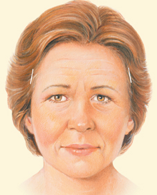 lateral facelift